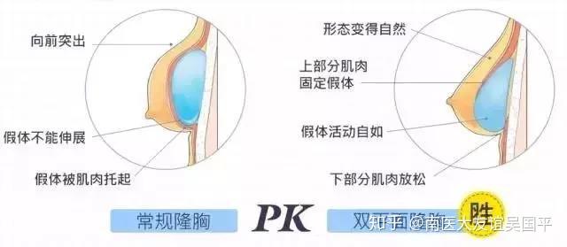 最新隆胸材料，革新与安全的双重保障